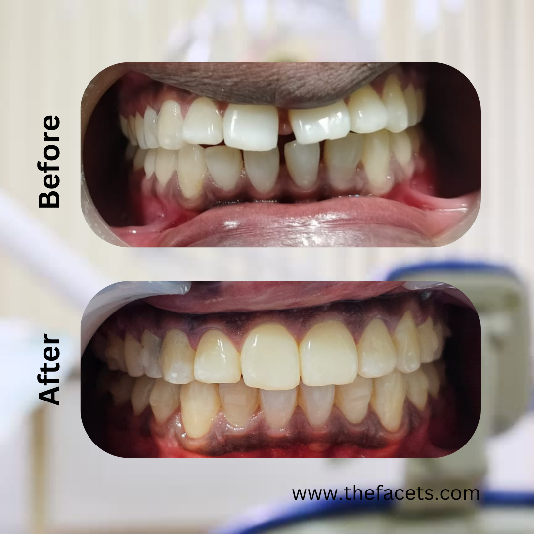 Before After 8
